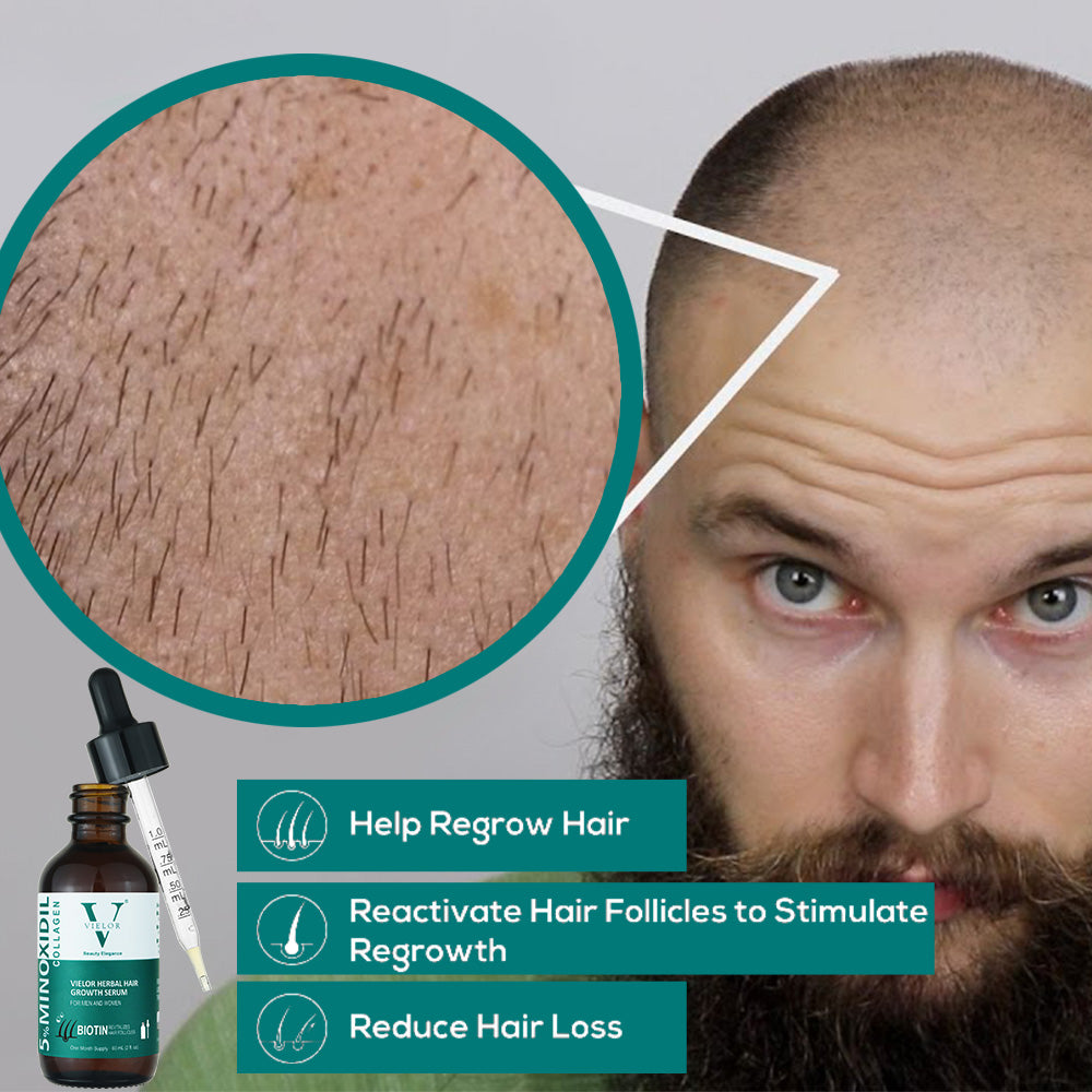 Vielor hair growth serum (5% minoxidil & biotin)