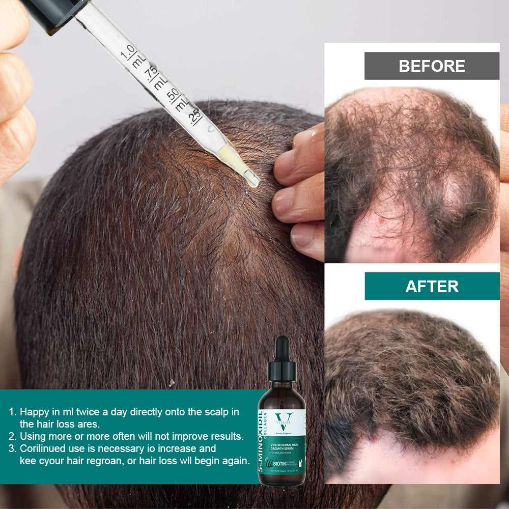 Vielor hair growth serum (5% minoxidil & biotin)